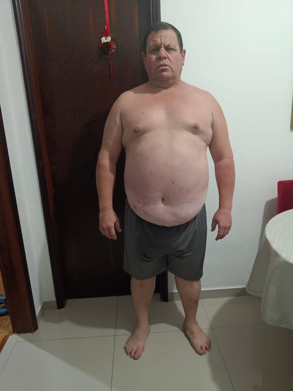 Fernando — antes do acompanhamento com Dr. Rodrigo Costta